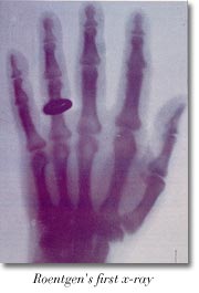 Roengten's first x-ray